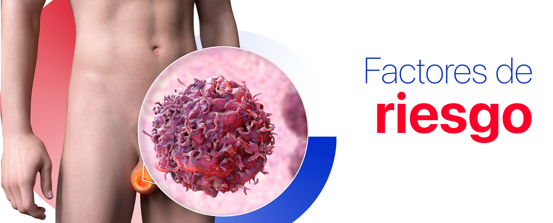 la prevención del cáncer de próstata se basa en la identificación de factores de riesgo