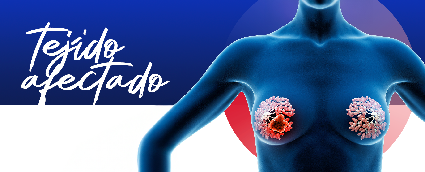 Cáncer de mama y su tejido afectado